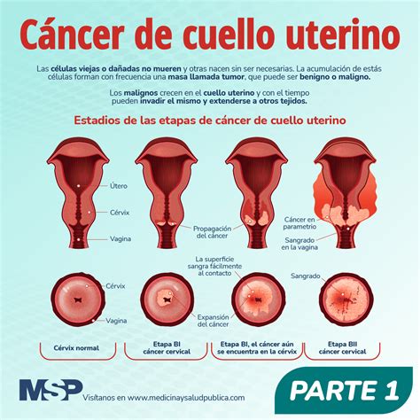 cancer de cuello uterino